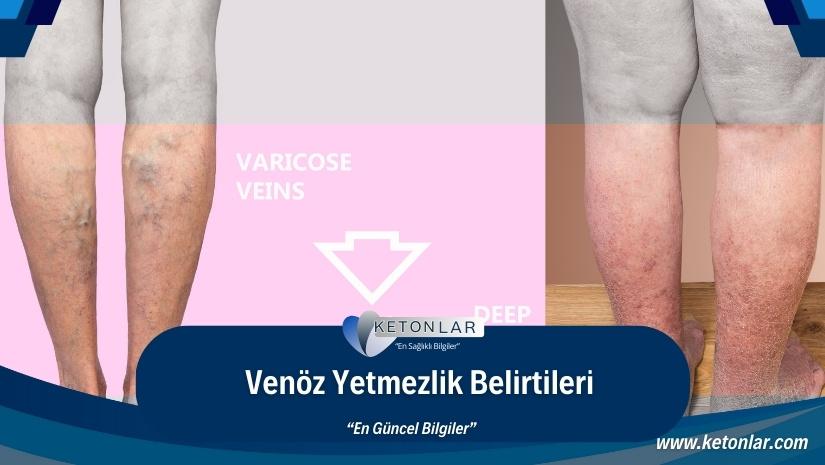 Venöz Yetmezlik Belirtileri Ve Doğal Tedavi Yöntemleri